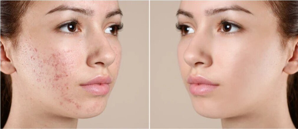 5 x Sulphur Soap Bars – Best Sulphur Acne Treatment for Eczema, Scabies & Skin Fungus – Handmade in the UK – Only £24.99 with Free P&P - Herbalshire Handmade Herbal Products