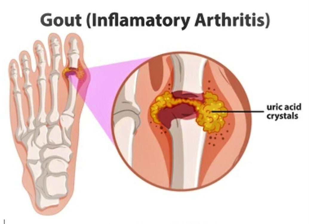 Gout Pain Relief Cream Natural Herbal Gouty Arthritis Soothing Balm Ease Pain - Herbalshire Handmade Herbal Products