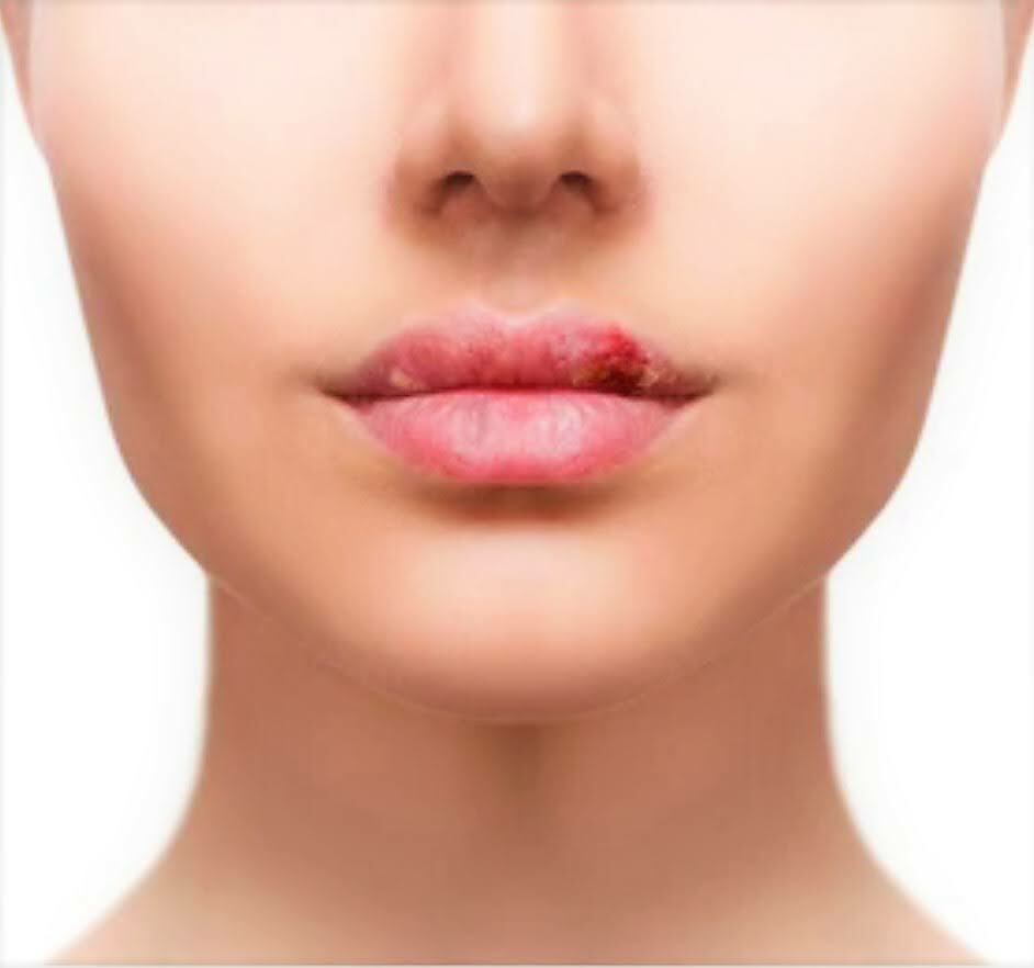 Herbal Lip Oil Lotion Natural Cold Sore Relief - Prevents and Soothes Cold Sores - Herbalshire Handmade Herbal Products