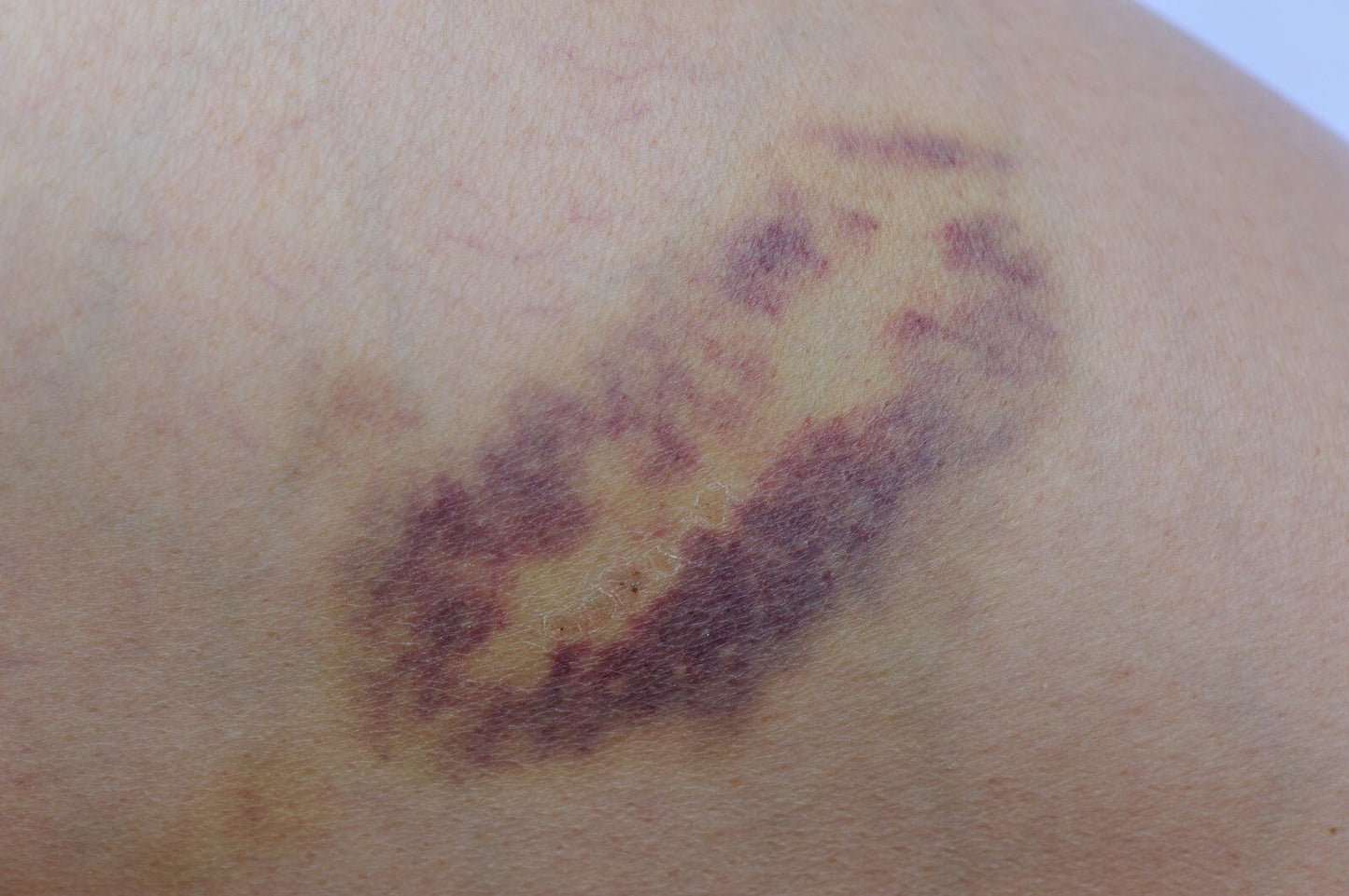 Natural Handmade Arnica Oil for Massage and Bruising - Relief and Healing Oil - Herbalshire Handmade Herbal Products
