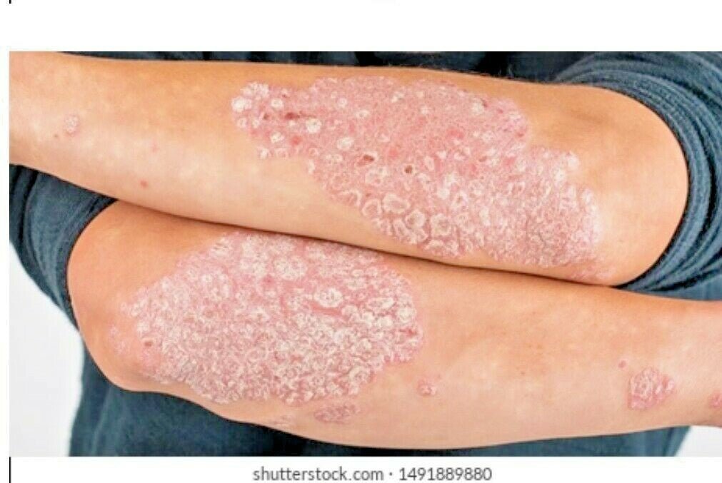 Beauty Body Psoriasis Cream for Eczema Skin Healing - Herbalshire Handmade Herbal Products