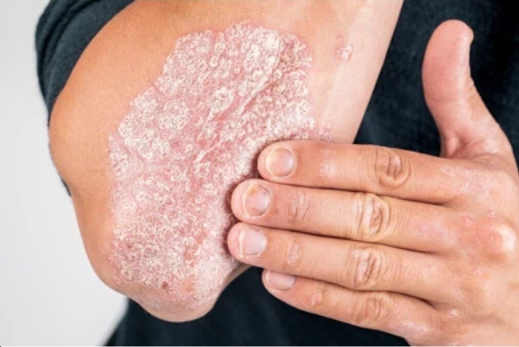 Beauty Body Psoriasis Cream for Eczema Skin Healing - Herbalshire Handmade Herbal Products