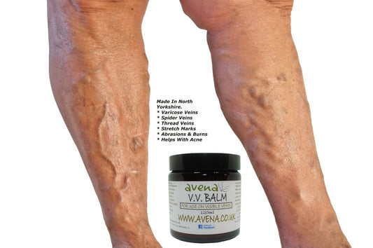 Varicose Vein Cream Vein Care Fading Cream Vein Cream Spider Veins Scars Soothe - Herbalshire Handmade Herbal Products