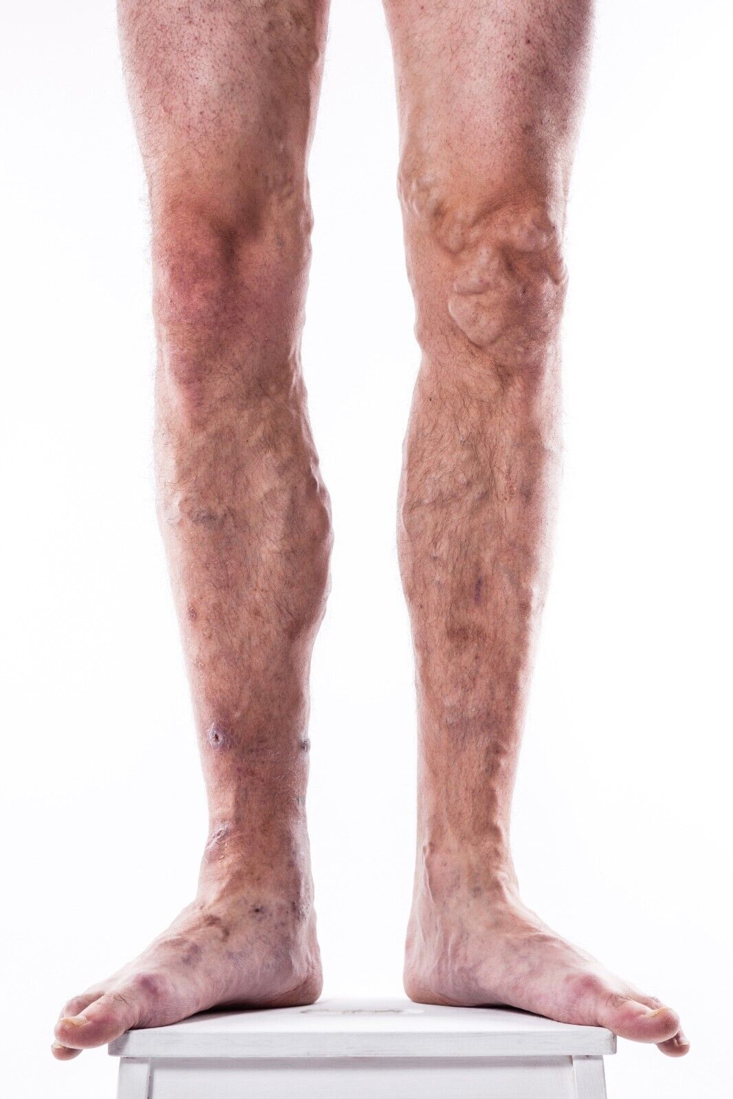 Veins Calendula Balm - Natural Treatment for Visible Veins, Varicose Veins, Acn - Herbalshire Handmade Herbal Products