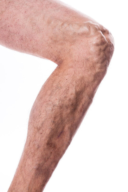 Veins Calendula Balm - Natural Treatment for Visible Veins, Varicose Veins, Acn - Herbalshire Handmade Herbal Products