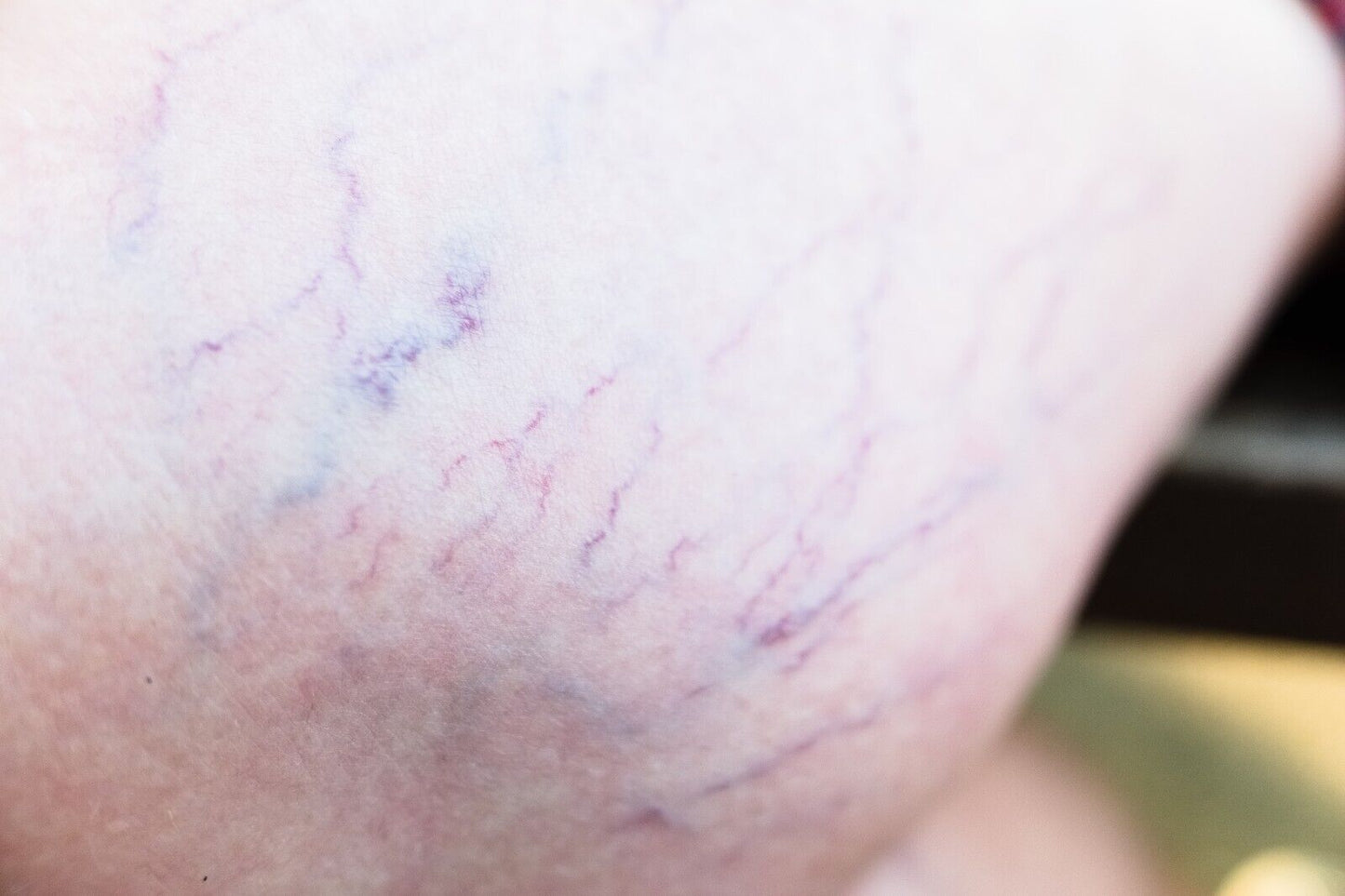 Veins Calendula Balm - Natural Treatment for Visible Veins, Varicose Veins, Acn - Herbalshire Handmade Herbal Products