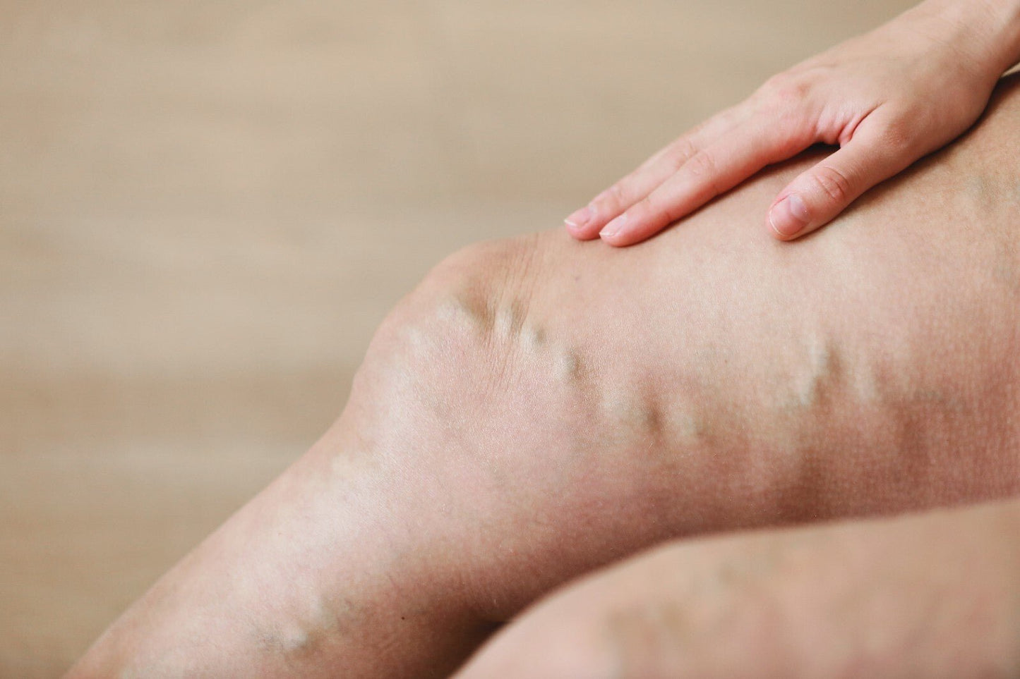 VV Calendula Balm - Natural Treatment for Visible Veins and Skin Conditions - Herbalshire Handmade Herbal Products