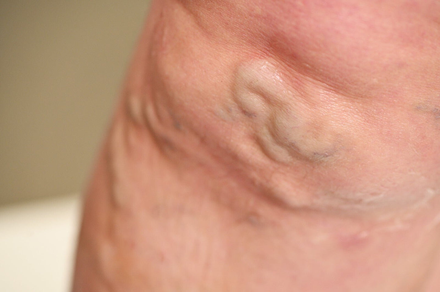 VV Calendula Balm - Natural Treatment for Visible Veins and Skin Conditions - Herbalshire Handmade Herbal Products