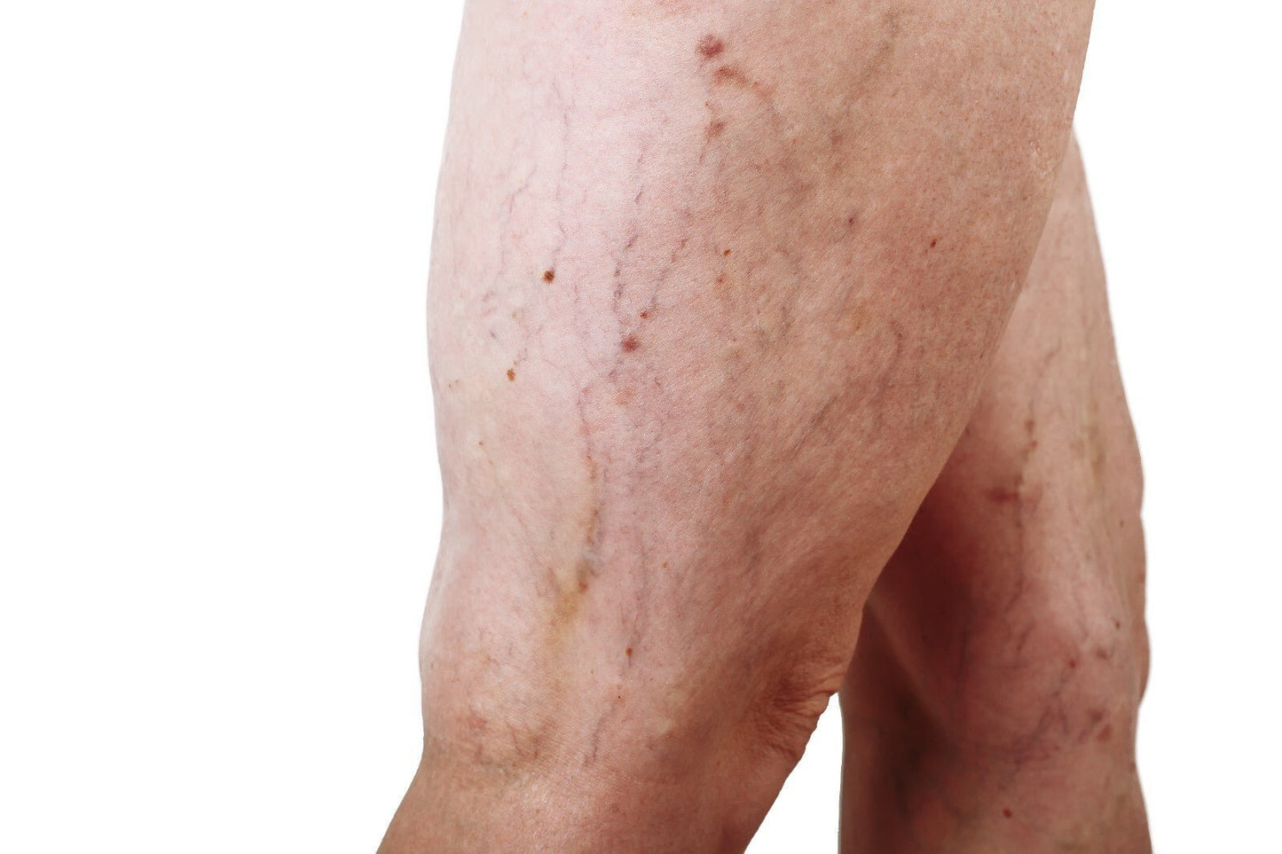 VV Calendula Balm - Natural Treatment for Visible Veins and Skin Conditions - Herbalshire Handmade Herbal Products