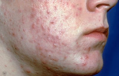 Herbalshire Natural Sulphur Cream - Vegan & Cruelty - Free - Acne, Scabies, Rosac - Herbalshire Handmade Herbal Products