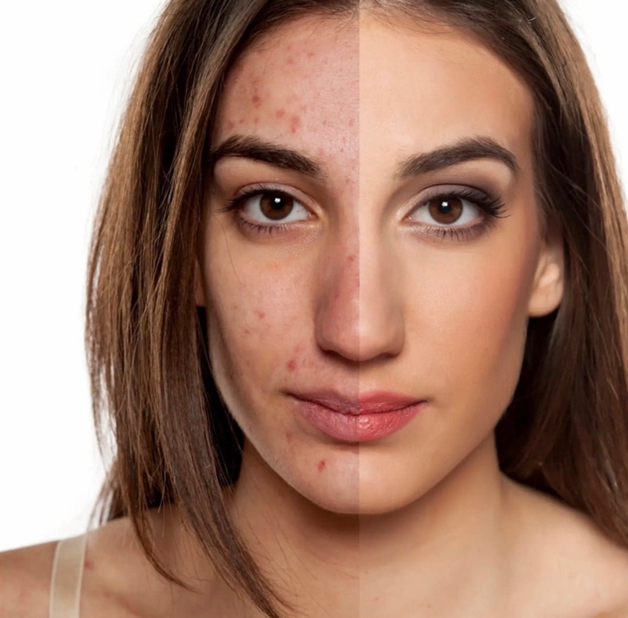 Natural acne treatment before and after results using herbal skincare.