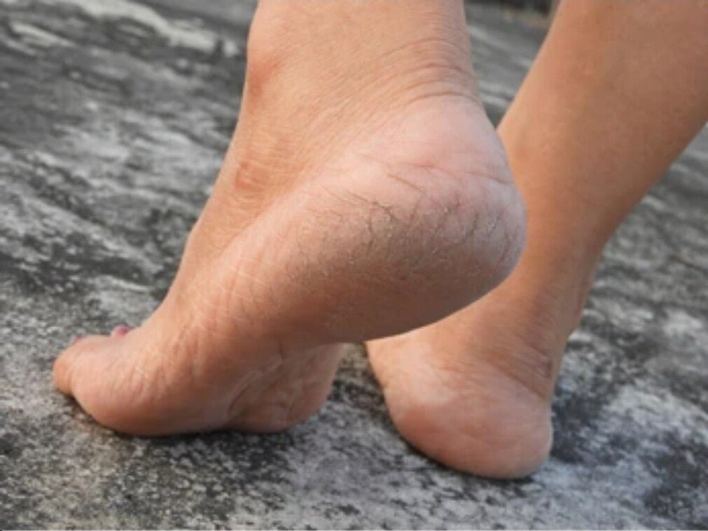 Active Foot Rescue Balm For Cracked Heels, Very Dry Skin & Athletes Foot Cream - Herbalshire Handmade Herbal Products