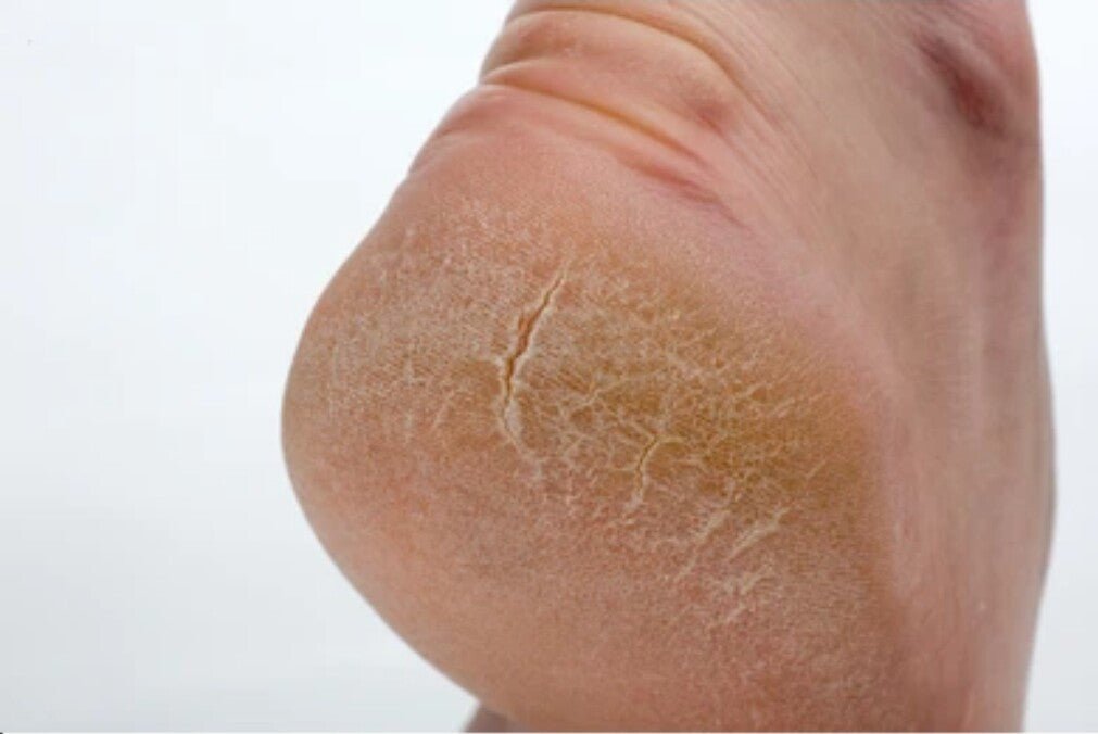 Active Foot Rescue Balm For Cracked Heels, Very Dry Skin & Athletes Foot Cream - Herbalshire Handmade Herbal Products