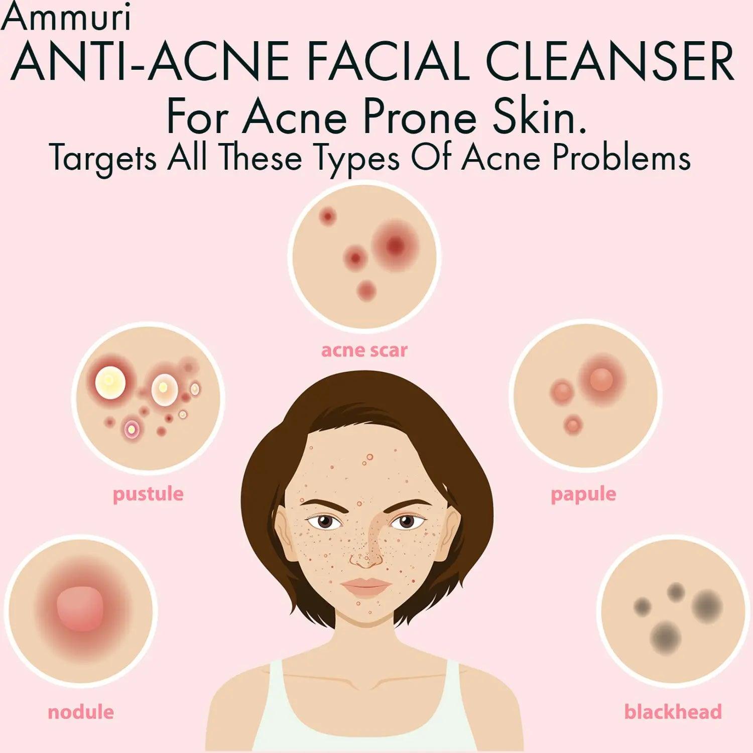 Ammuri Anti Acne Facial Cleanser for Acne Prone Skin - Herbalshire Handmade Herbal Products