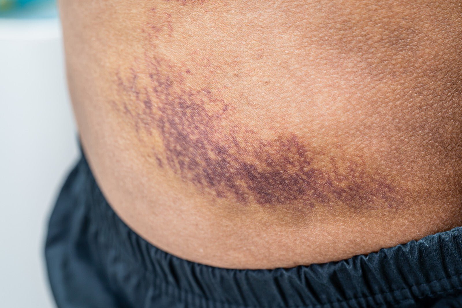 Arnica Cream for Bruises & Scars – Handmade Herbal Ointment - Herbalshire Handmade Herbal Products