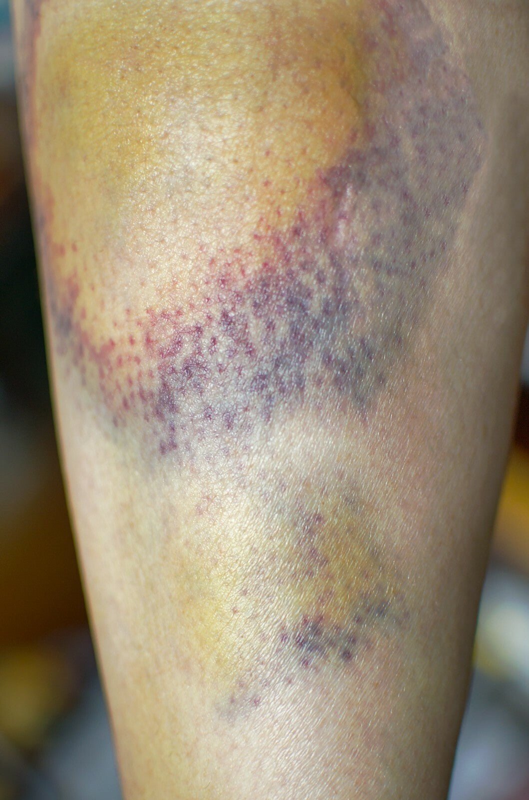 Arnica Cream for Bruises & Scars – Handmade Herbal Ointment - Herbalshire Handmade Herbal Products