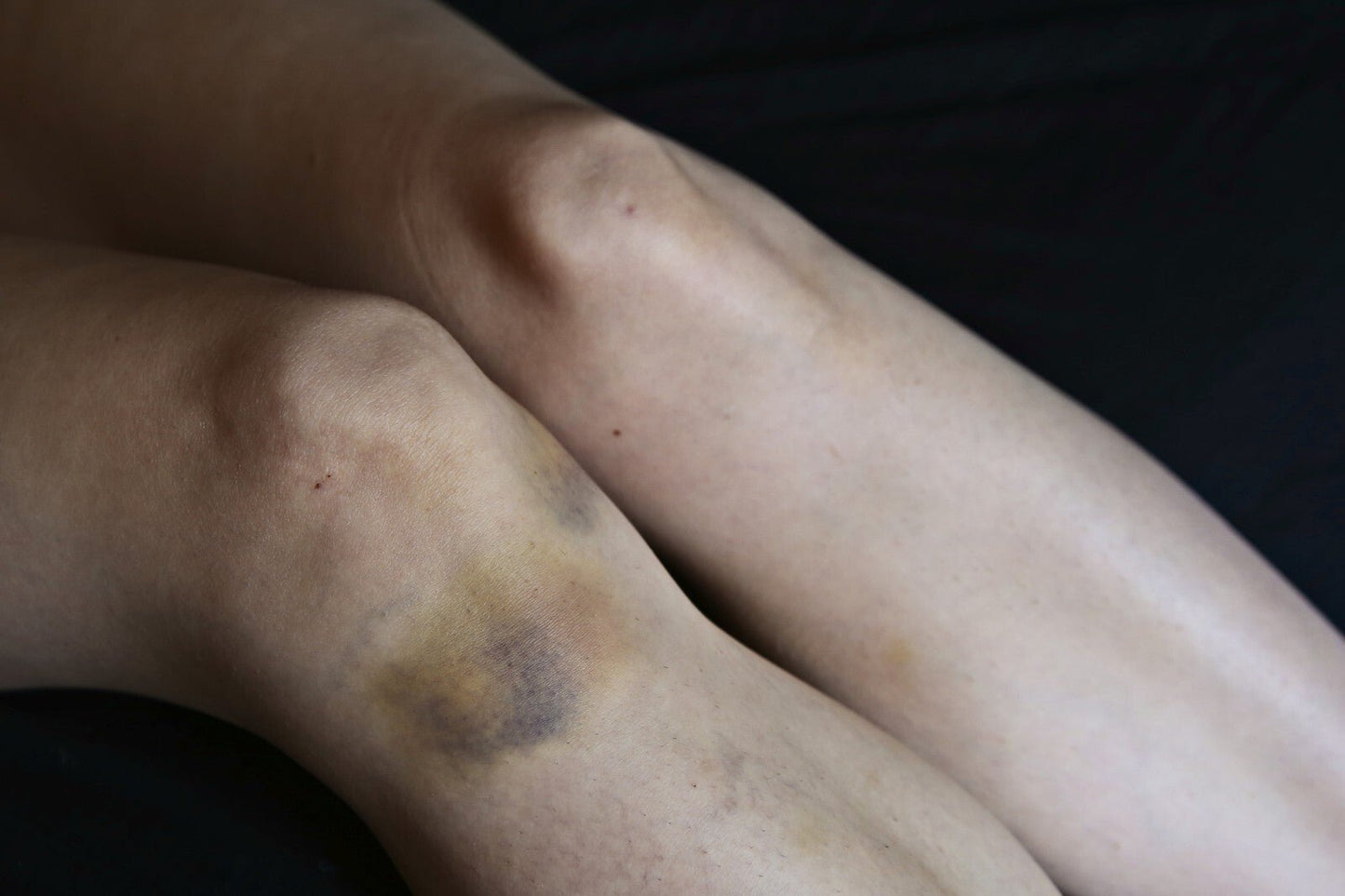 Arnica Cream for Bruises & Scars – Handmade Herbal Ointment - Herbalshire Handmade Herbal Products