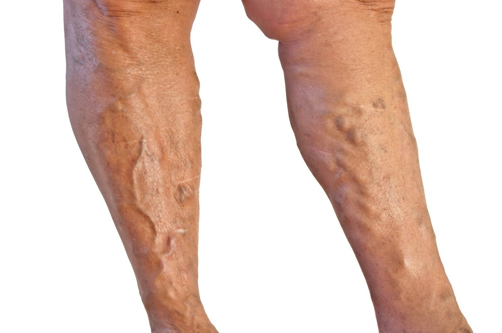 Calendula Oil Varicose Veins 50ml Natural Soothing Eczema Swelling Bruising Oil - Herbalshire Handmade Herbal Products