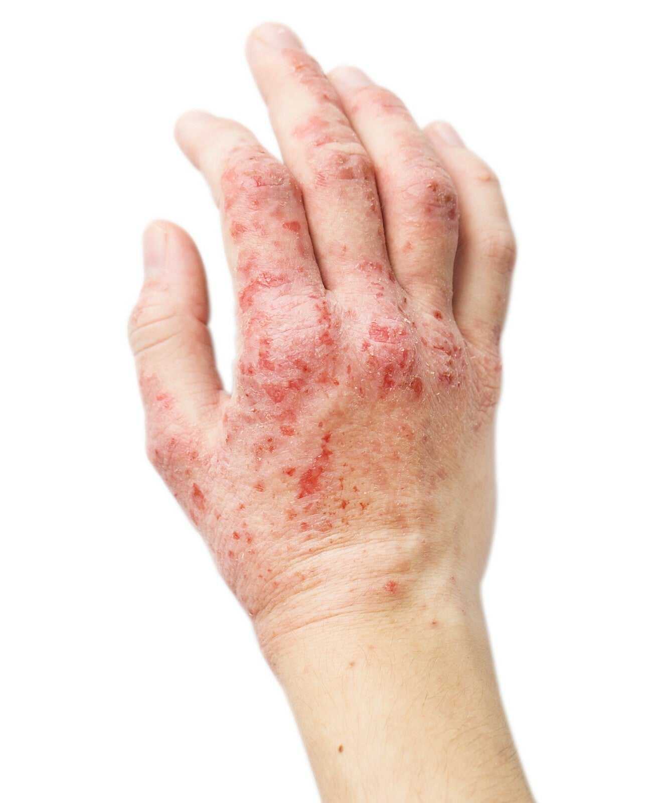Eczema Cream Adults Ultra Repair Cream Emulsifying Ointment Face Cream Exma - Herbalshire Handmade Herbal Products