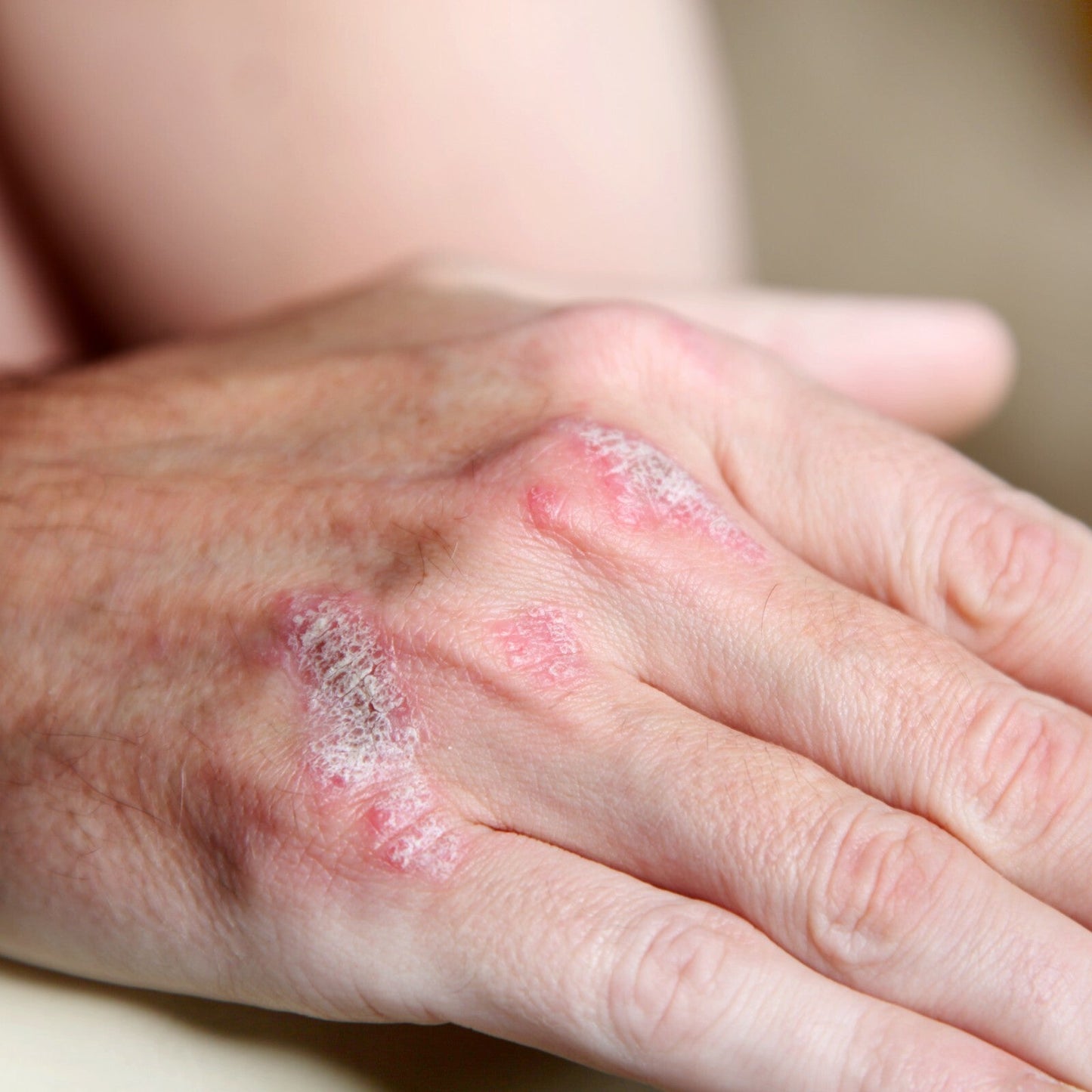 Eczema Cream Adults Ultra Repair Cream Emulsifying Ointment Face Cream Exma - Herbalshire Handmade Herbal Products
