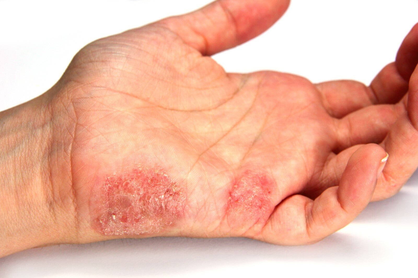 Eczema Cream Adults Ultra Repair Cream Emulsifying Ointment Face Cream Exma - Herbalshire Handmade Herbal Products