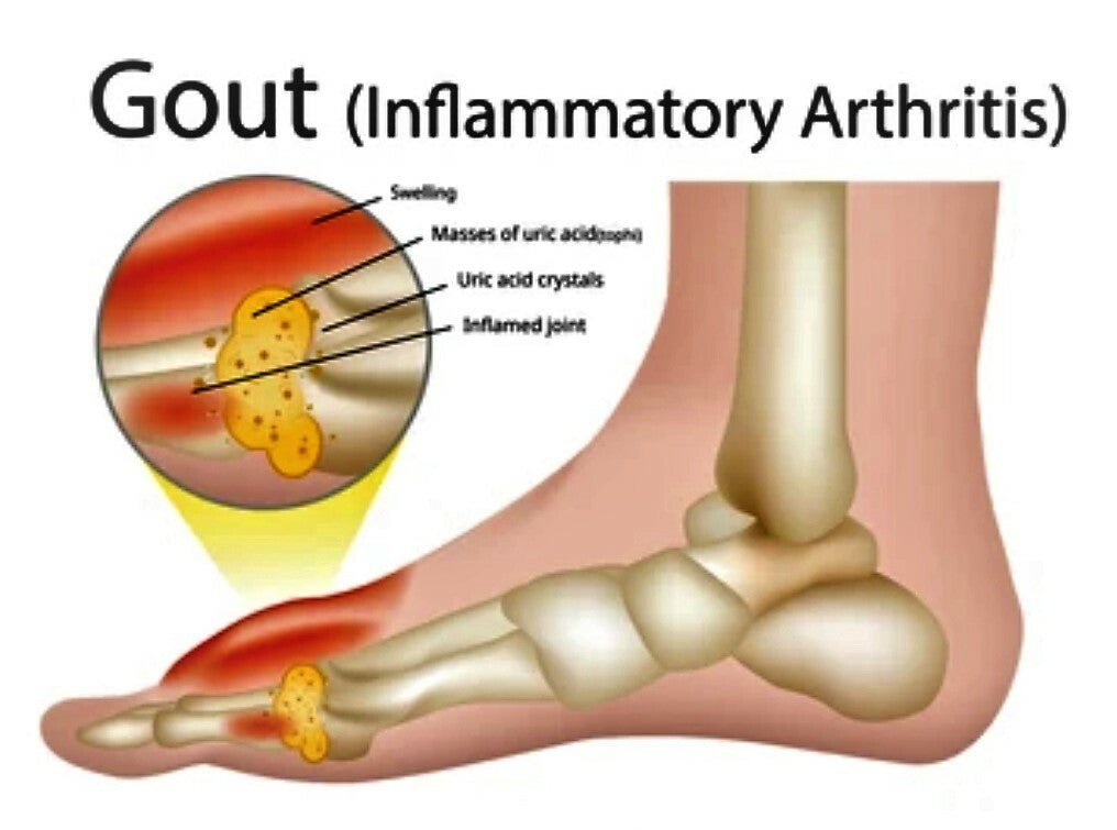 Gout Relief Cream Natural Herbal Balm – Arthritis Pain Ointment UK Handmade - Herbalshire Handmade Herbal Products