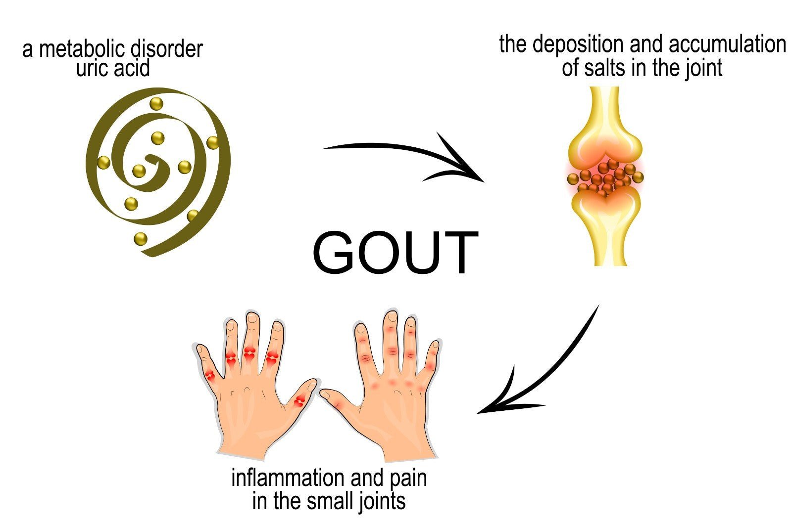 Gout Treatment Herbal Cream - Natural Pain Relief for Gout Arthritis - Handmade - Herbalshire Handmade Herbal Products