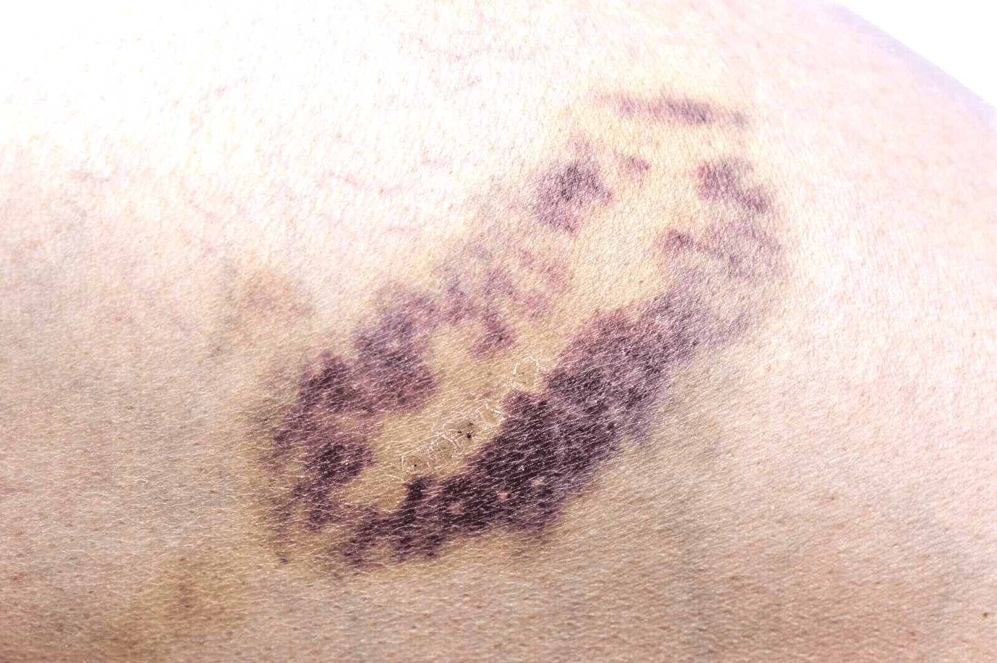 Handmade Arnica Balm Salve Natural Relief for Bruises, Aches & Muscles UK Made - Herbalshire Handmade Herbal Products