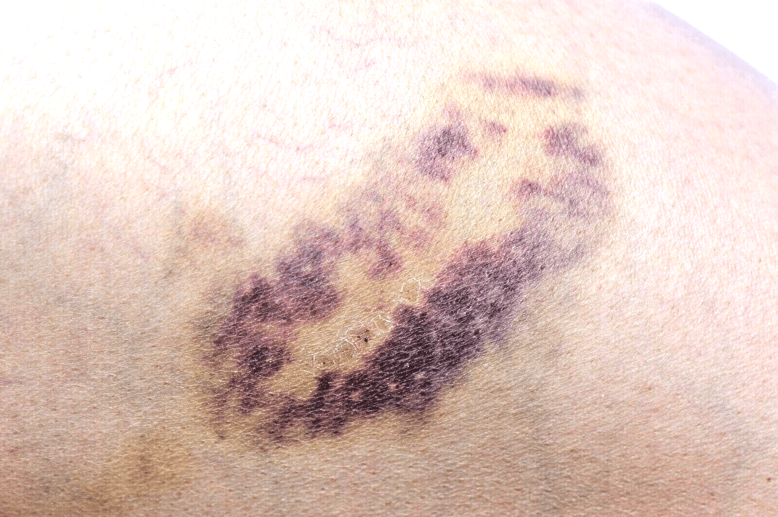 Handmade Arnica Balm Salve Natural Relief for Bruises, Aches & Muscles UK Made - Herbalshire Handmade Herbal Products