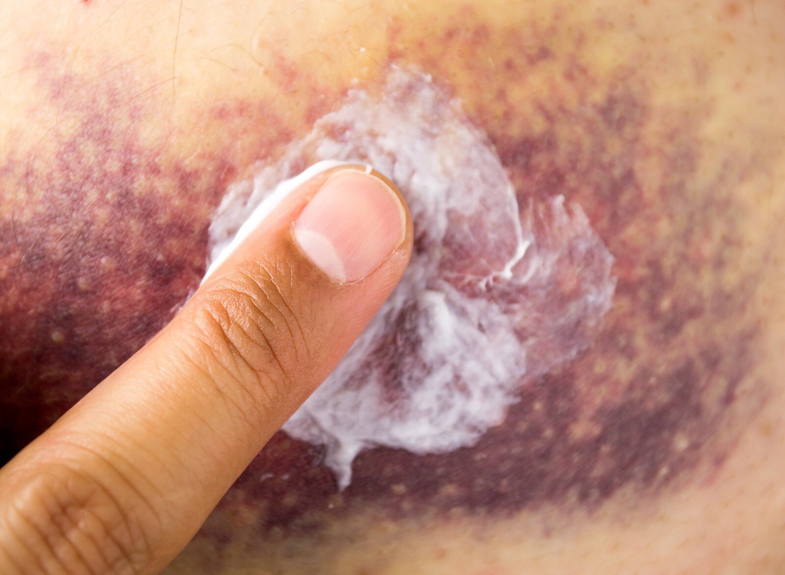 Handmade Arnica Balm Salve Natural Relief for Bruises, Aches & Muscles UK Made - Herbalshire Handmade Herbal Products