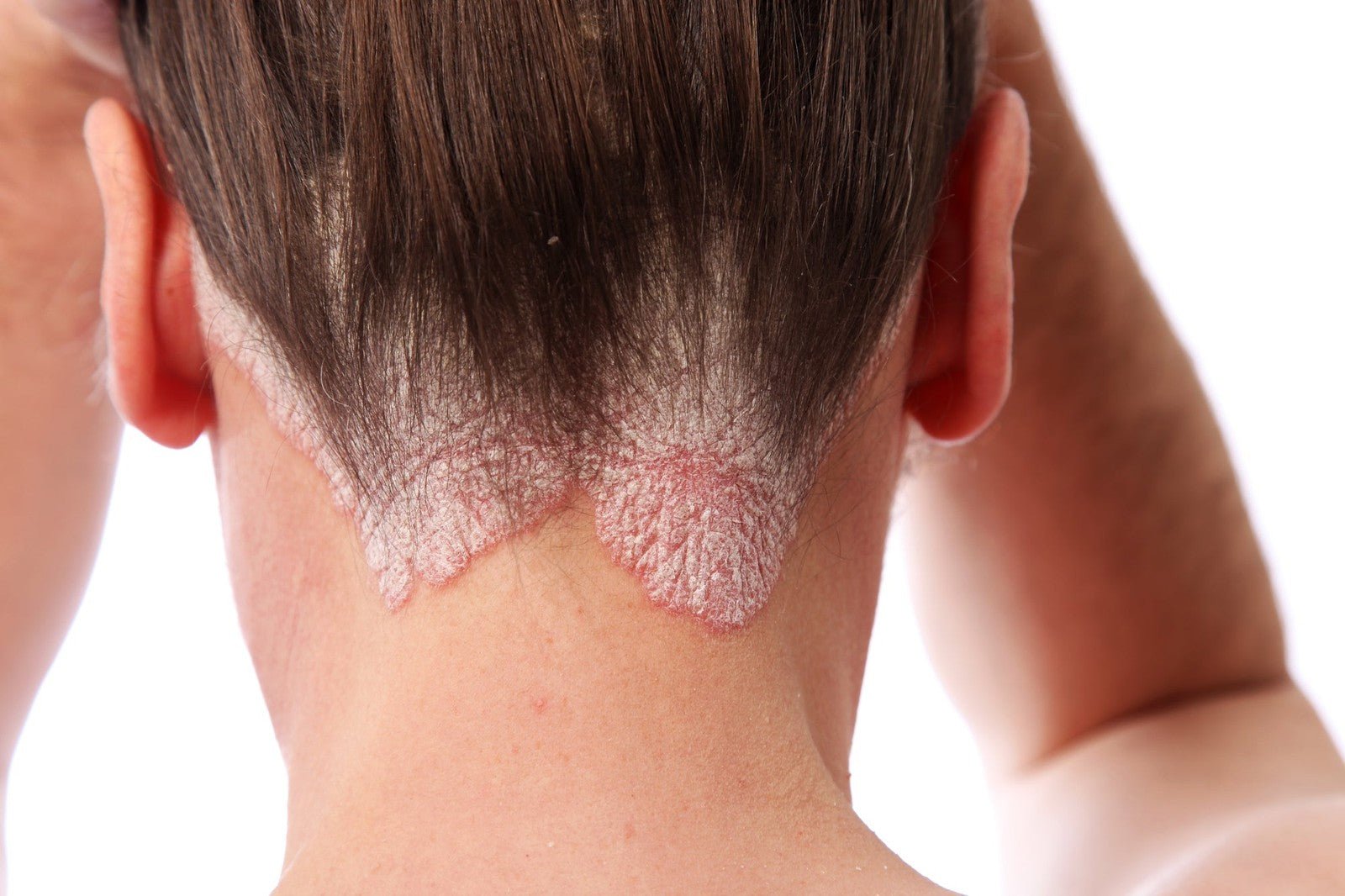Handmade Psoriasis Cream - Herbalshire Handmade Herbal Products