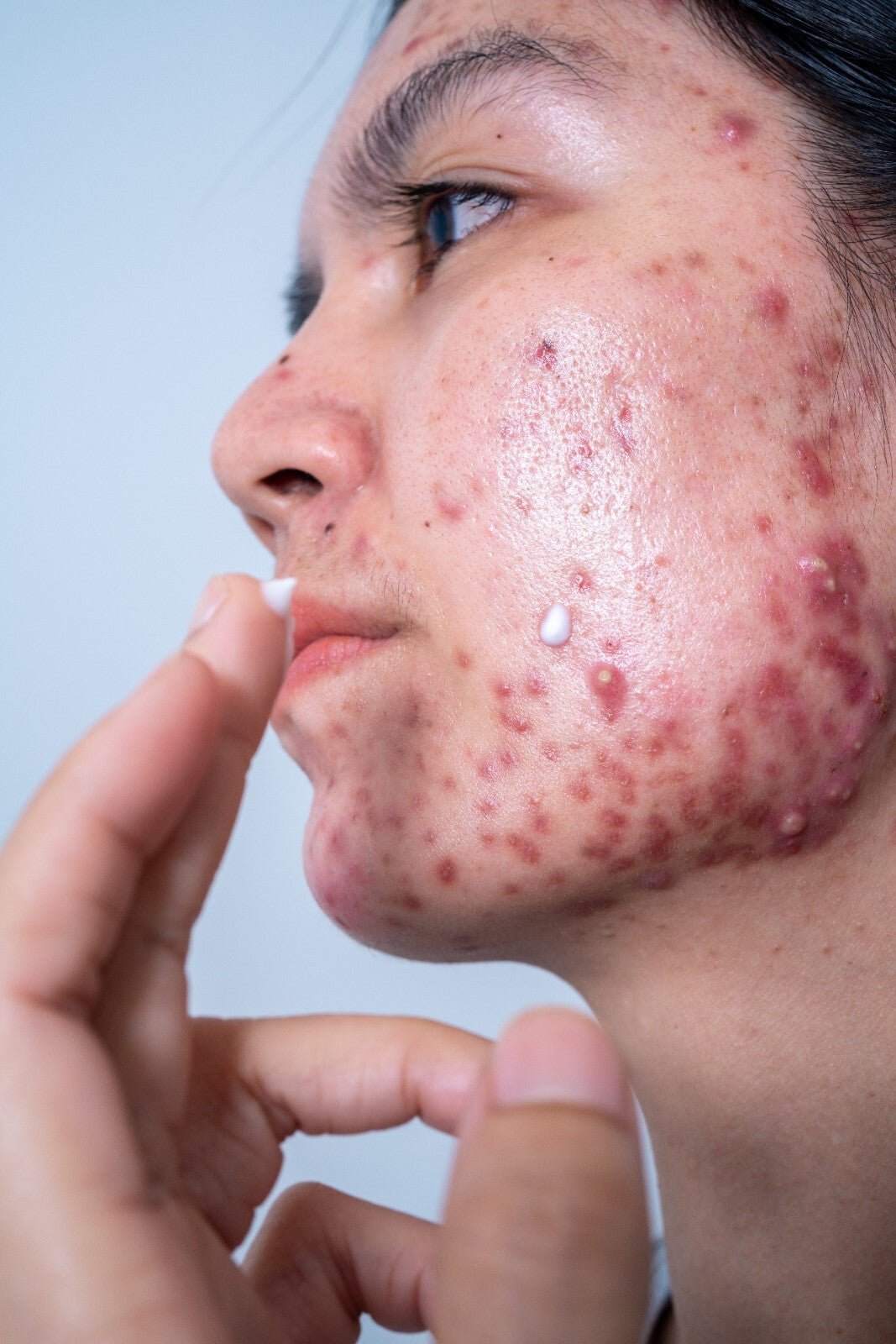 Handmade Sulphur Soap – 200g Block for Acne, Scabies, Rosacea Eczema Relief - Herbalshire Handmade Herbal Products