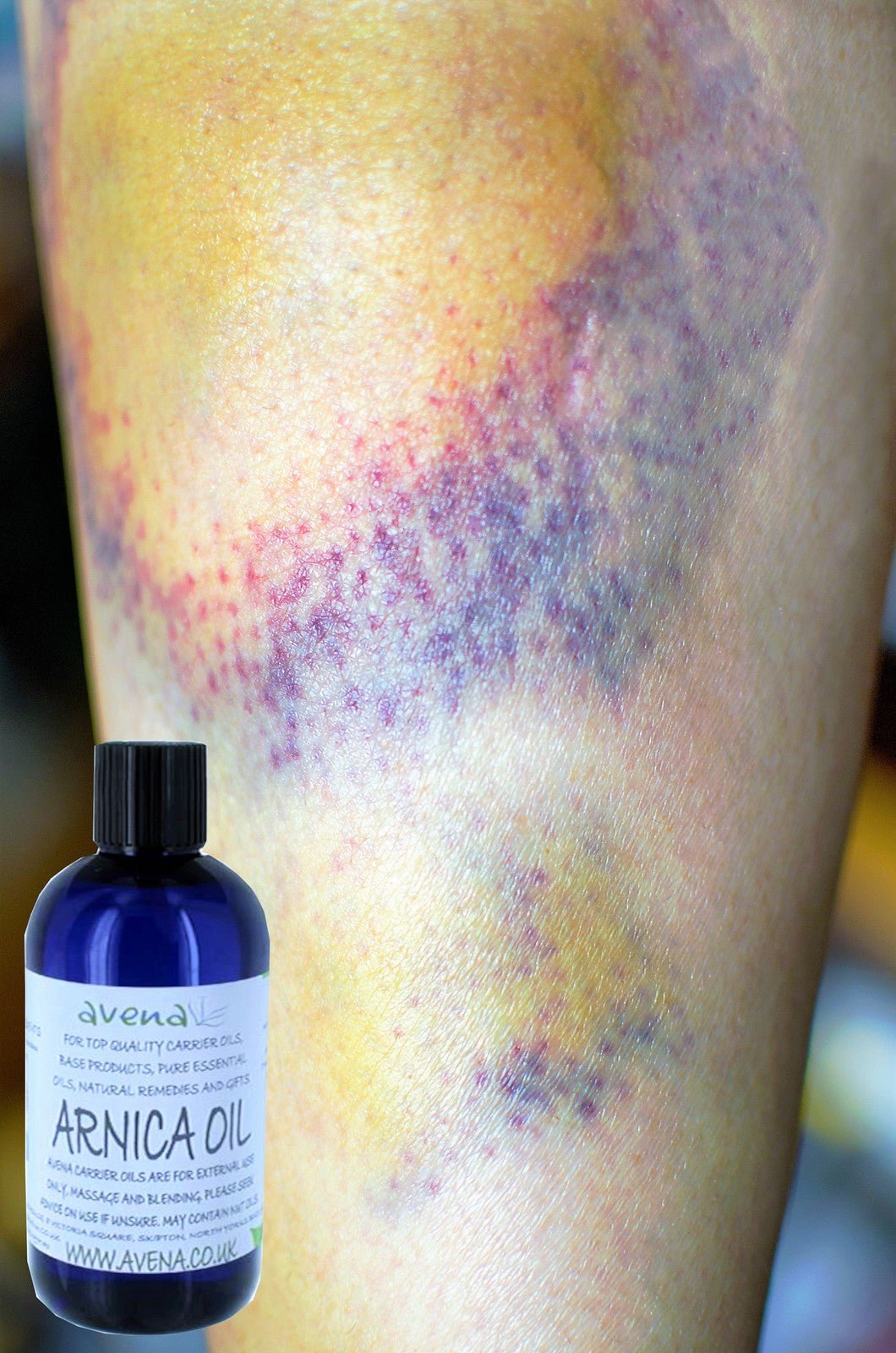 Herbalshire Premium Arnica Ointment & Oil - Natural Relief for Bruising & Swell - Herbalshire Handmade Herbal Products