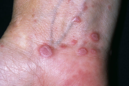 Lichen Planus Relief Oil 100 ml - Lichen Planus Rash - Anti - inflammatory Herbal - Herbalshire Handmade Herbal Products