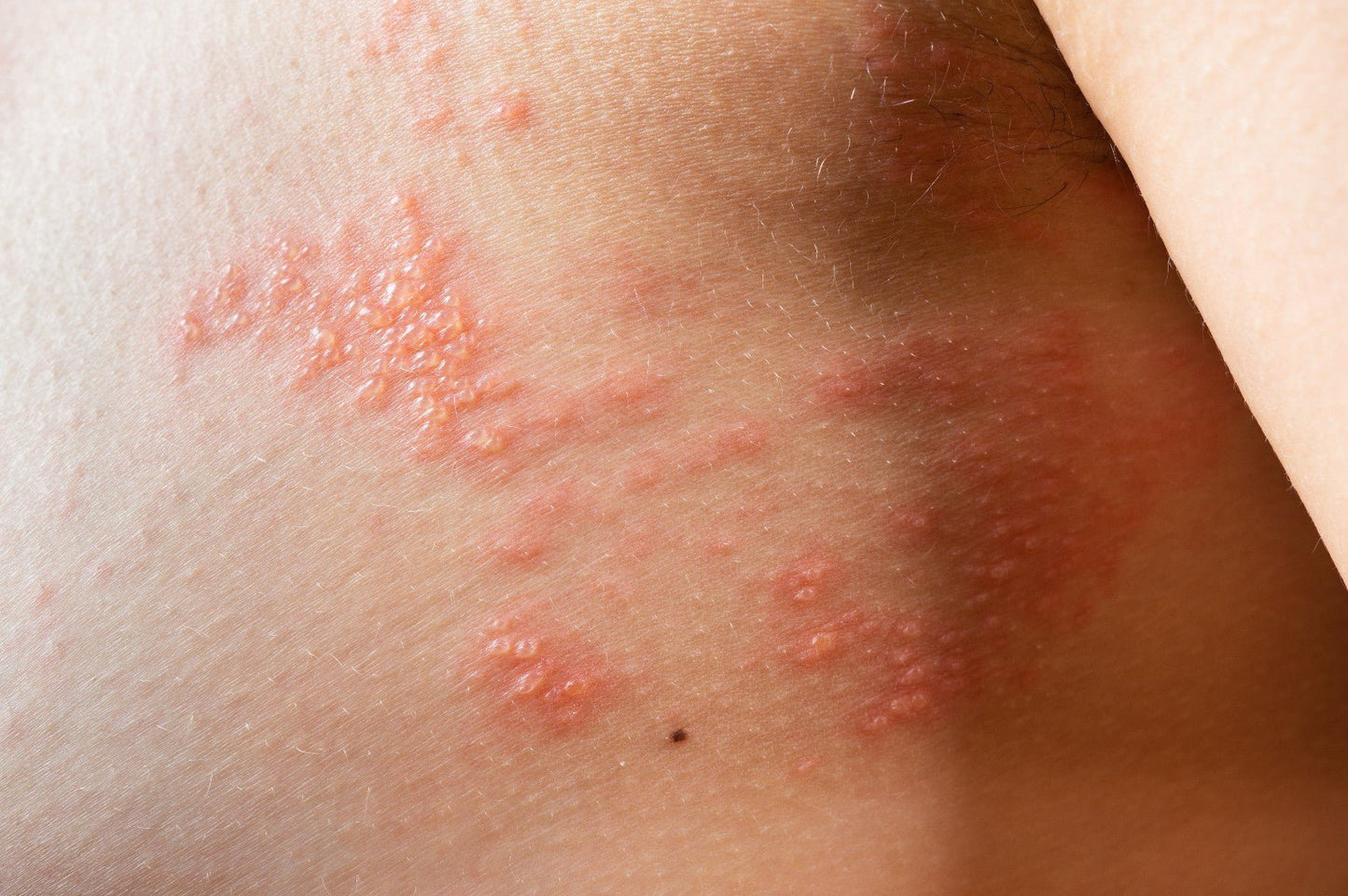 Lichen Planus Relief Oil 100ml – Natural Herbal Rash & Itchy Skin Treatment - Herbalshire Handmade Herbal Products