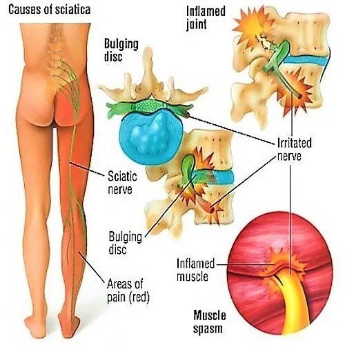 Natural Handmade Sciatica Oil - 250ML - Herbalshire - Pain Relief, Anti - Inflamm - Herbalshire Handmade Herbal Products