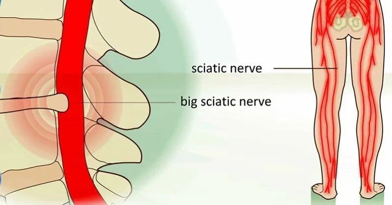 Natural Handmade Sciatica Oil - 250ML - Herbalshire - Pain Relief, Anti - Inflamm - Herbalshire Handmade Herbal Products