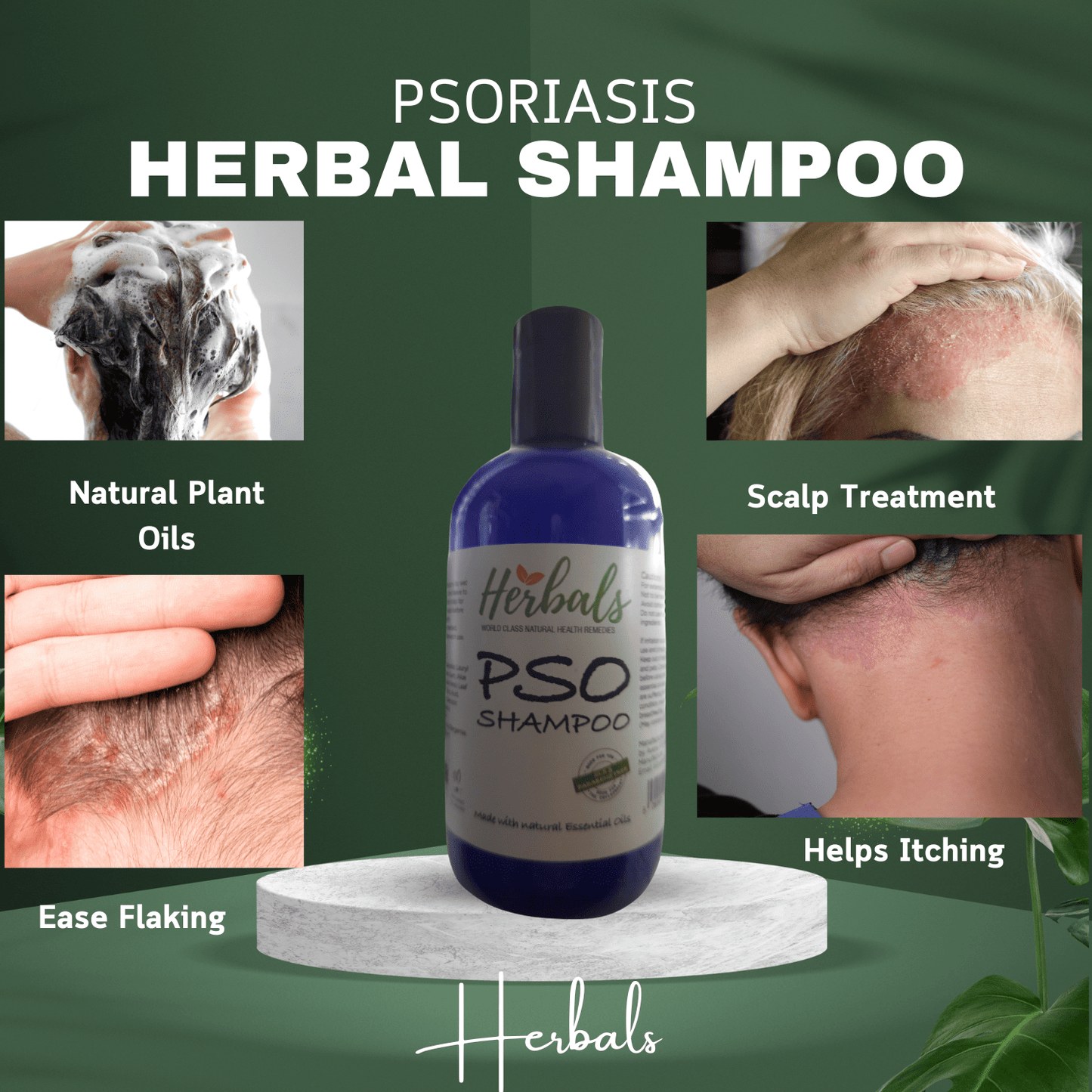 Natural Psoriasis Shampoo – Handmade Relief for Dry, Flaky, Itchy Scalp – 250ml - Herbalshire Handmade Herbal Products
