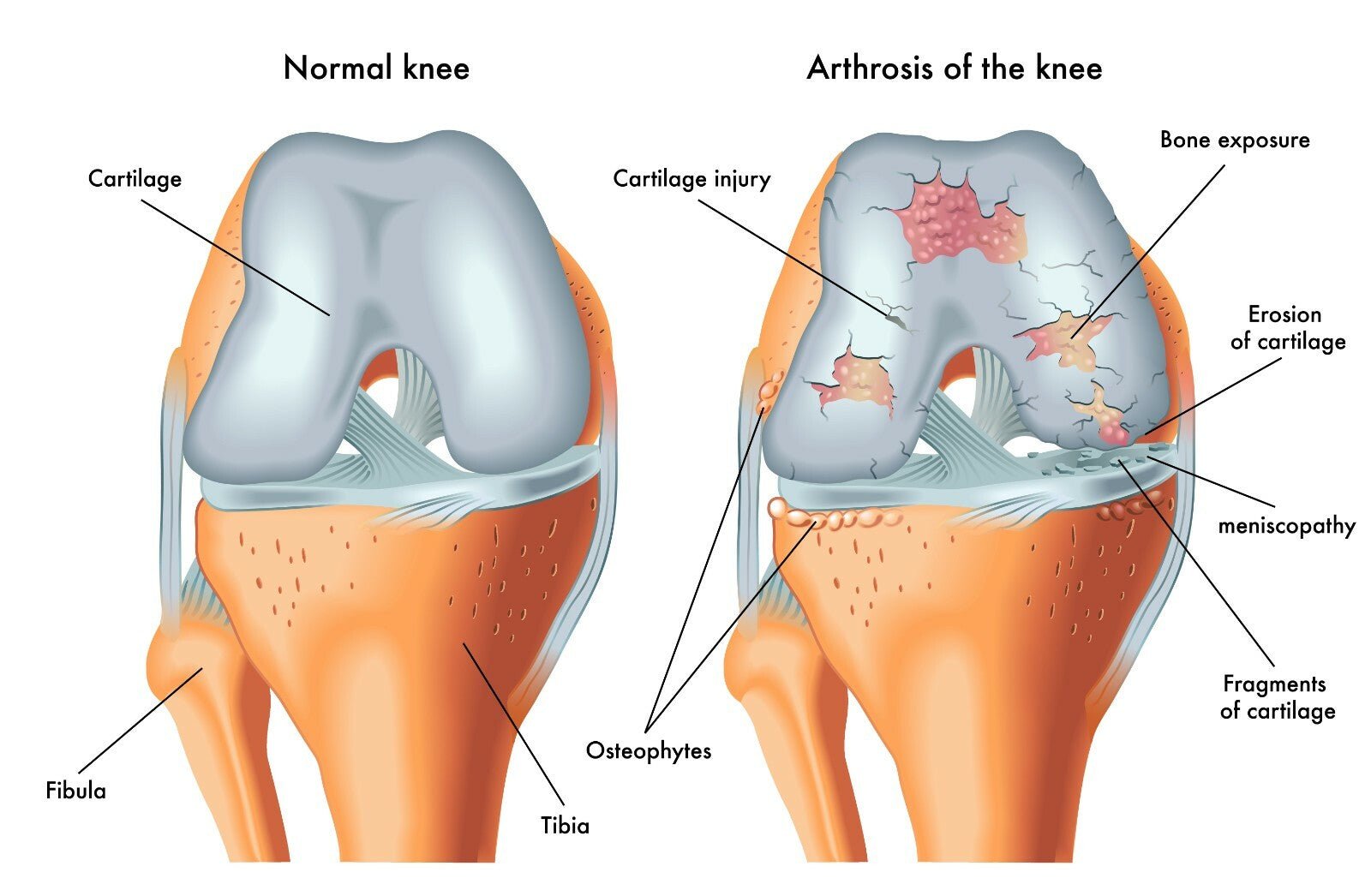 Osteoarthritis Cream Joint Knee Hip Fingers Pain Relief Fibromyalgia Flare Up - Herbalshire Handmade Herbal Products