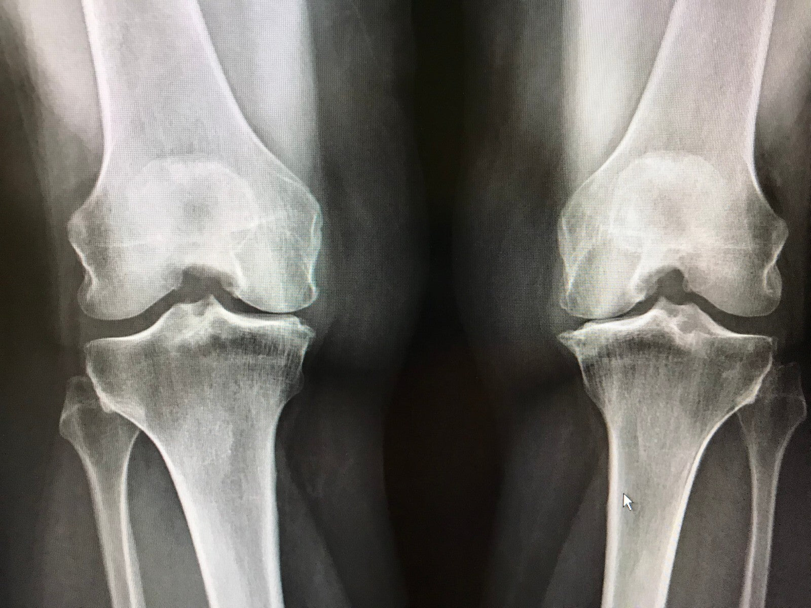 Osteoarthritis Pain Relief Cream Joint Balm for Knee Hip Spine Hands UK - Herbalshire Handmade Herbal Products