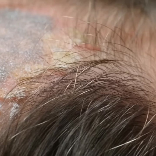 PSO Herbal Scalp Care Shampoo - Effective Dandruff Treatment & Soothing Psoriasis Relief