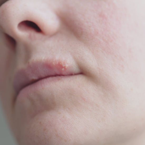Woman with cold sore applying herbal lip oil lotion for natural cold sore relief – antiseptic, antifungal lip treatment for dry, cracked lips – handmade skincare from Yorkshire.