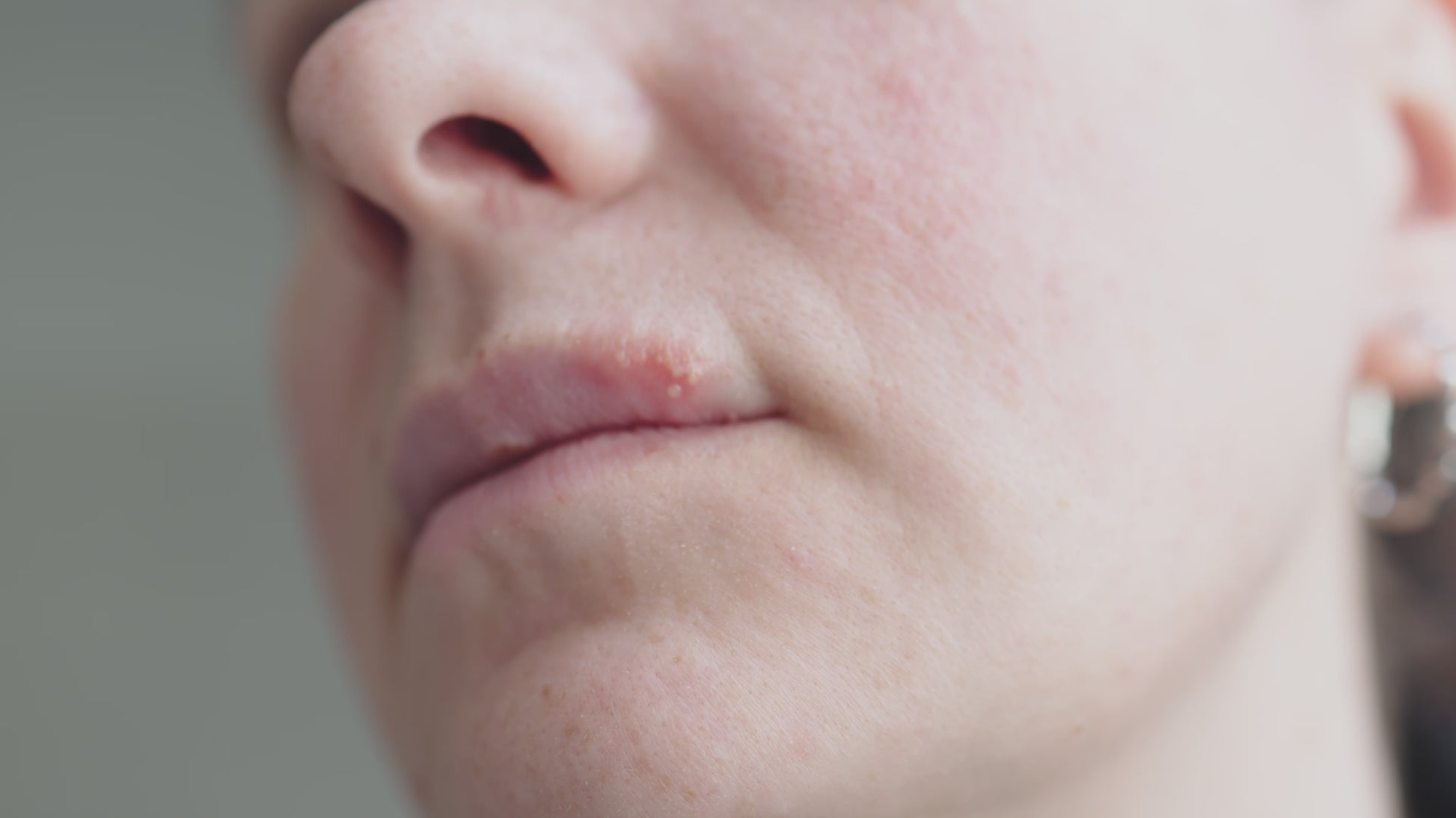 Woman with cold sore applying herbal lip oil lotion for natural cold sore relief – antiseptic, antifungal lip treatment for dry, cracked lips – handmade skincare from Yorkshire.