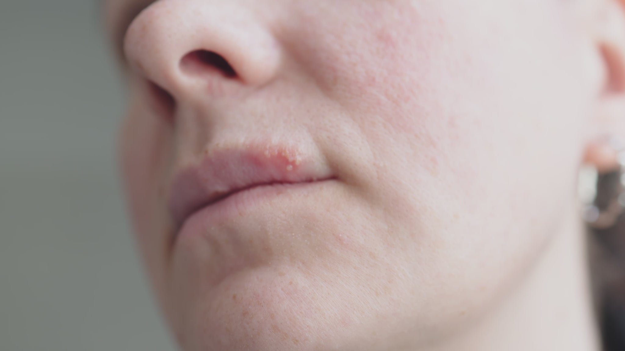 Woman with cold sore applying herbal lip oil lotion for natural cold sore relief – antiseptic, antifungal lip treatment for dry, cracked lips – handmade skincare from Yorkshire.