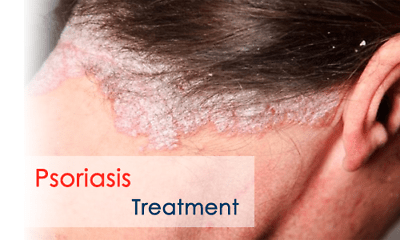 PSO Herbal Scalp Care Shampoo - Effective Dandruff Treatment & Soothing Psoriasis Relief - Herbalshire Handmade Herbal Products