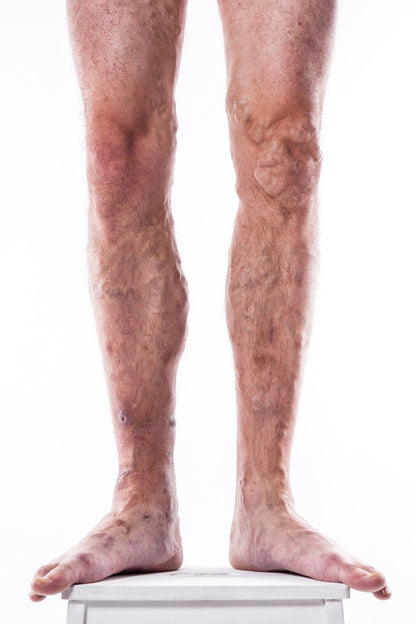 Veins Calendula Balm - Natural Treatment for Visible Veins, Varicose Veins, Acn