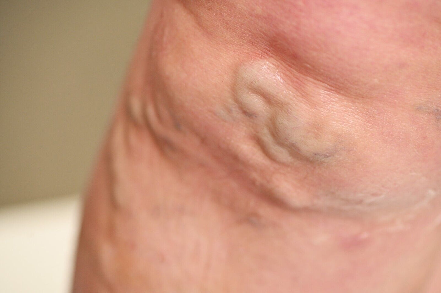 Veins Calendula Balm - Natural Treatment for Visible Veins, Varicose Veins, Acn