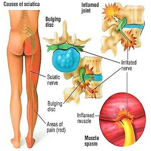 Natural Handmade Sciatica Oil - 250ML - Herbalshire - Pain Relief, Anti-Inflamm