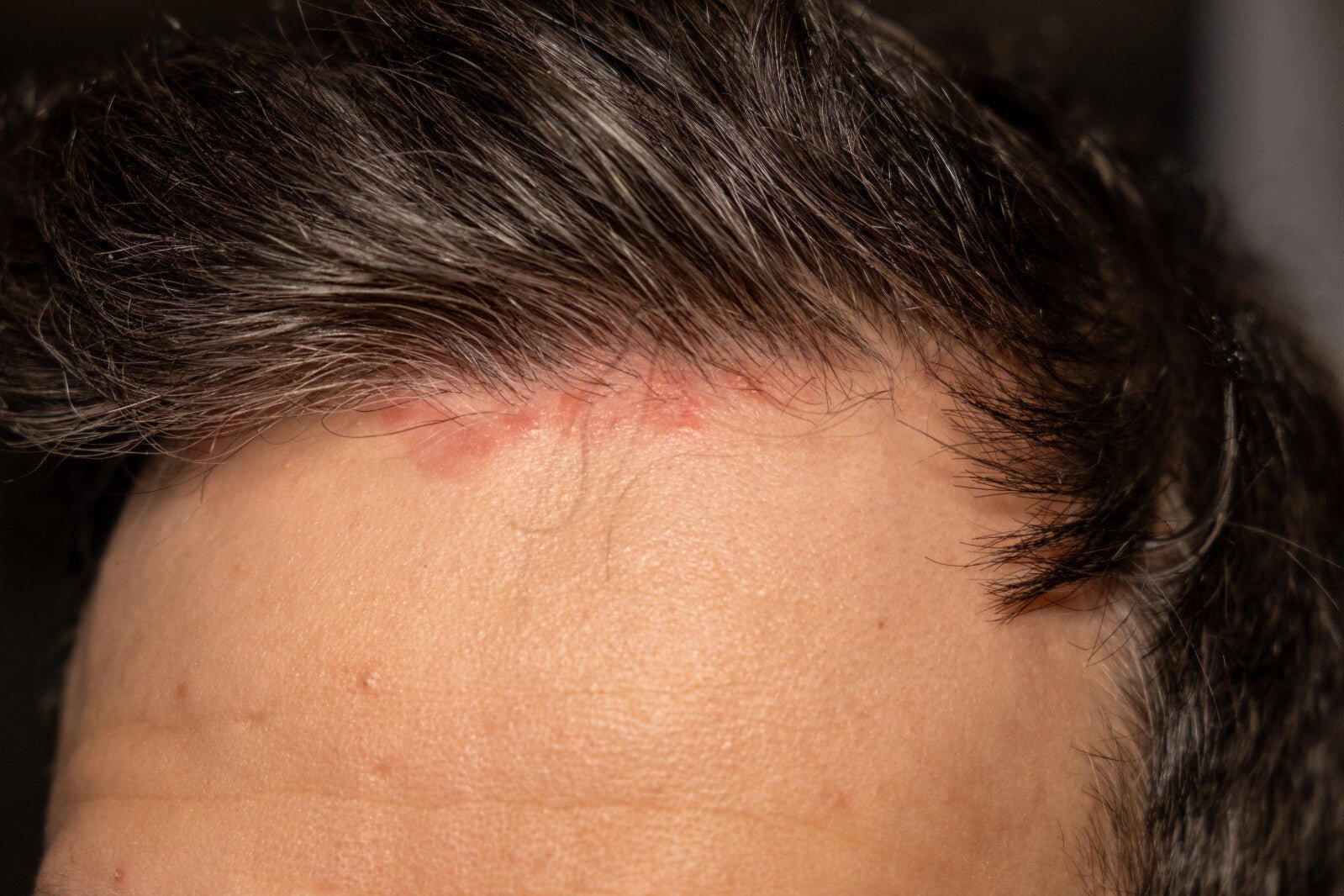 Scalp Psoriasis Treatment Shampoo Natural Handmade Relief for Flaky Itchy Scalp - Herbalshire Handmade Herbal Products