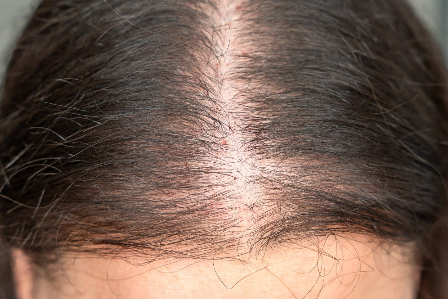 Scalp Psoriasis Treatment Shampoo Natural Handmade Relief for Flaky Itchy Scalp - Herbalshire Handmade Herbal Products